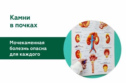 Лечение мочекаменной болезни