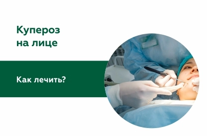 Как лечить купероз на лице и чего следует избегать?