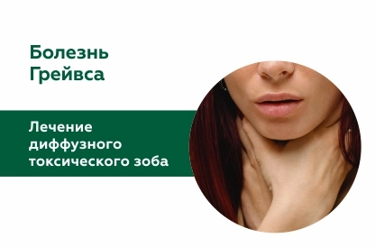 Лечение диффузного токсического зоба