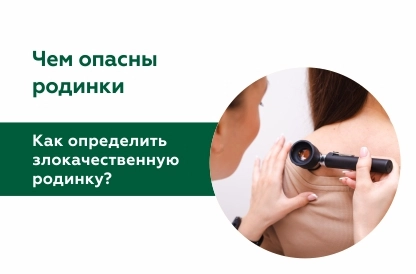 Как определить злокачественную родинку?